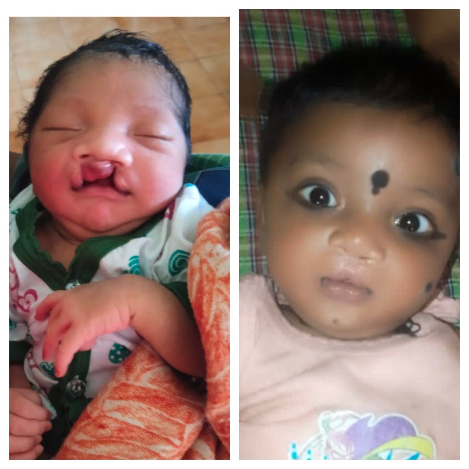 जब सरकारी योजना बनी सहारा: जन्म से कटे होंठ-तालू वाले मासूम को मिली नई मुस्कान